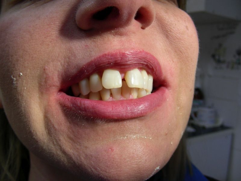 Előre álló nagymetsző fogak diasztémával